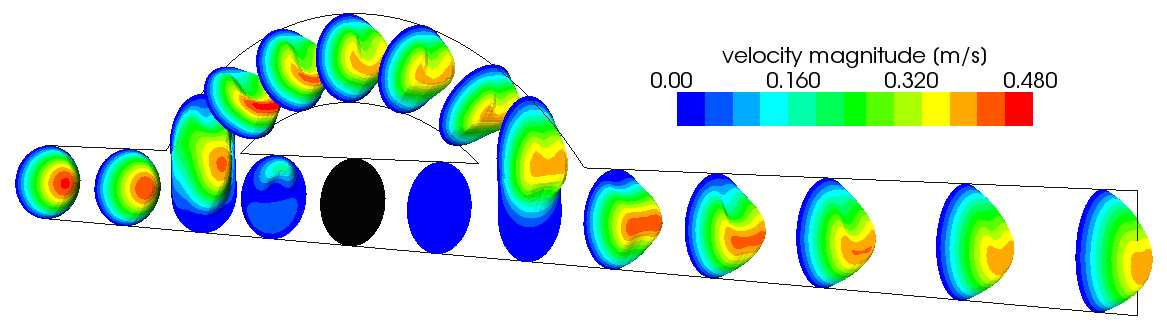 3D koronární bypass s oklzí (Re=30, D=6,8mm, α=45 ), newtonská kapalina