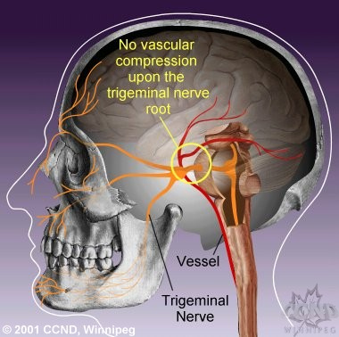 NEMOCNICA Neuralgia trigeminu Etiológia v.s. fokálna demyelinizácia n.v. alebo ganglia Tzv.