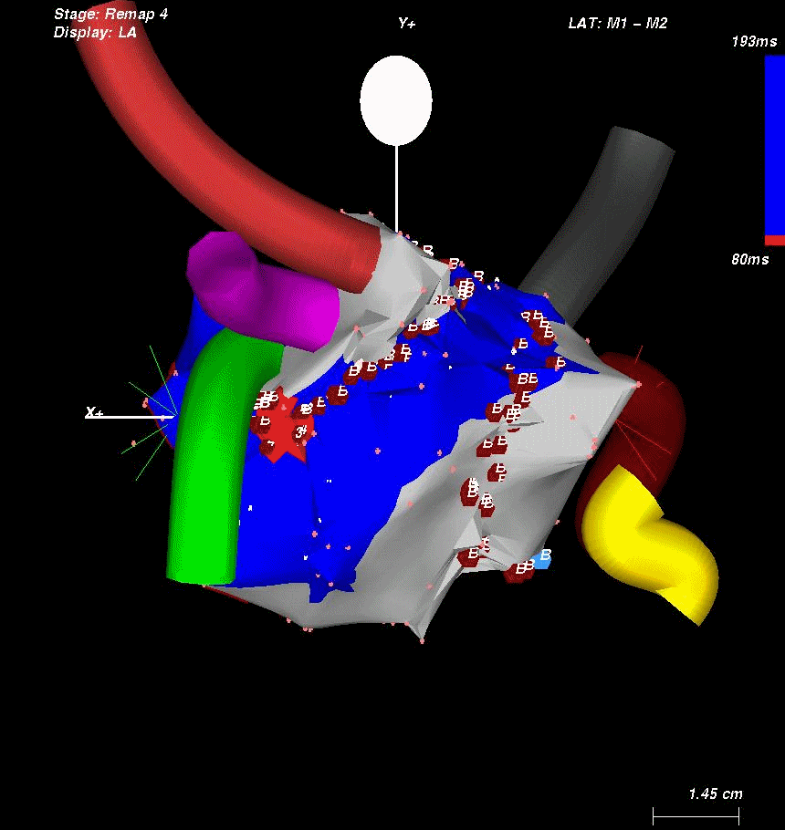 Obr.4 žíly na levou síň 3D propagační mapa.