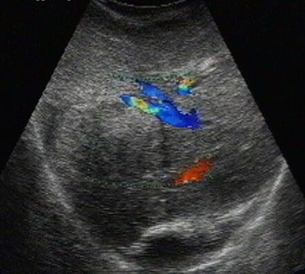 4.4.1 Sonografie Sonografie neboli ultrazvukové vyšetření je pro diagnostiku nádorů jater metodou první volby, zejména pro svojí snadnou dostupnost a neinvazivitu, časovou nenáročnost a nízkou cenu
