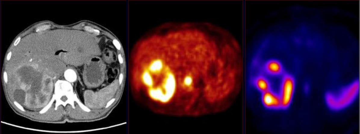 PET, pozitronová emisní tomografie, zobrazuje metabolické a biochemické procesy pomocí radiofarmak, která se aktivně vychytávají v buňkách se zvýšenou metabolickou aktivitou.