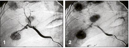 4.4.5 Angiografie Angiografie je invazivní vyšetření sloužící k zobrazení cévního řečiště.