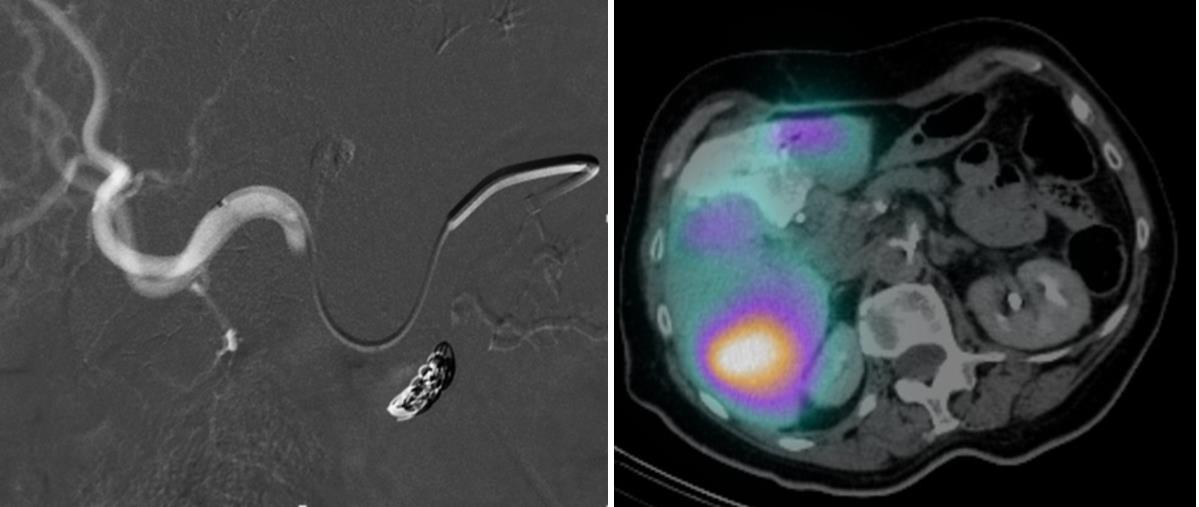 radioembolizace může vést k selhání jater. Toxické účinky radioembolizace jsou ve srovnání s chemoembolizací nižší.