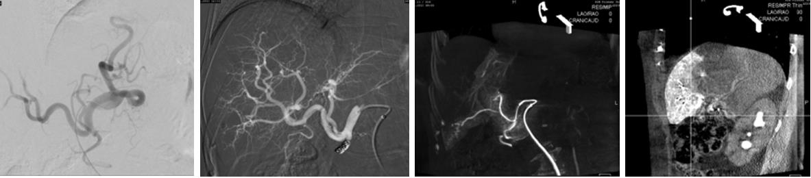 Obrázek 28: Angiografie jaterních tepen