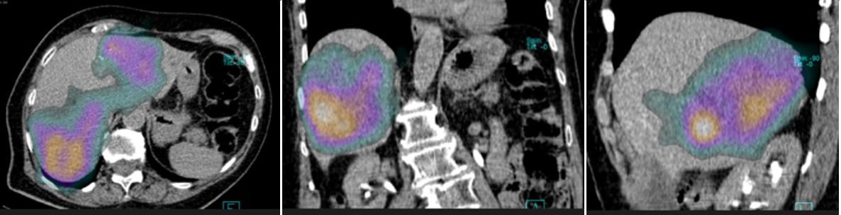 Obrázek 31: SPECT/CT břicha,