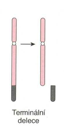 strukturní přestavby delece vznik zlomů a ztráta úseku chromosomu, který způsobuje vznik nebalancovaného karyotypu (parciální monosomie) na 1 chromosomu v páru úsek přítomen je, na druhém chybí