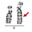 strukturní přestavby duplikace nadbytečný chromosomový segment, který způsobuje vznik nebalancovaného karyotypu Obr.