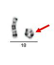 strukturní přestavby neobvyklé typy chromosomů marker chromosomy malé chromosomy (s centromerou), často v mozaice, obtížně identifikovatelné (mohou být vrozené nebo kultivačního původu) marker