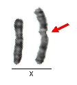 strukturní přestavby neobvyklé typy chromosomů izochromosomy metacentrické chromosomy, jejichž 1 raménko chybí a druhé je duplikováno (parciální monosomie 1 raménka a parciální trisomie 2.