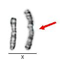 (izochromosomy) viz mechanismus vzniku izochromosomů Obr.