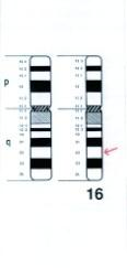 strukturní přestavby derivovaný chromosom robertsonovská translokace 45,XX,der(13;14) chromosom u nebalancovaného potomka rodičů nositelů balancované přestavby karyotyp matky 46,XX,t(16;21) Obr.