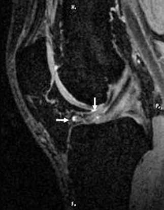 Edema confined only to the posterior process of the Hoffa s fat pad but without the inferior patellar plica limited Hoffa s disease ( ).