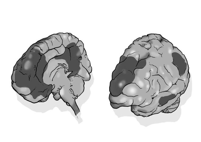 2.3 Anatomie Default mode network Endogenní síť DMN se skládá z částí frontálního laloku, parietálního laloku a částí temporálního laloku.