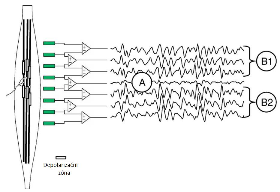 Obrázek 6 Příklad bipolárně snímaného EMG signálu zaznamenaného řadou lineárních elektrod při silné kontrakci svalu vastus medialis.
