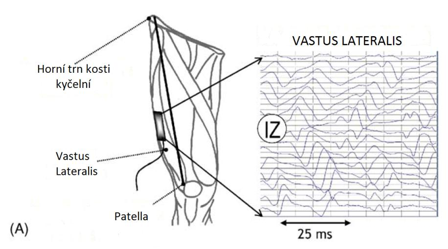 Obrázek 14 Umístění inervační zóny na svalech vastus lateralis (A) a vastus