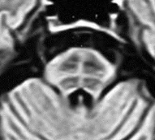 V diagnostice MSA se uplatňují také MRI metody. Abnormality basálních ganglií a mozkového kmene se mohou objevovat již v časných stádiích.