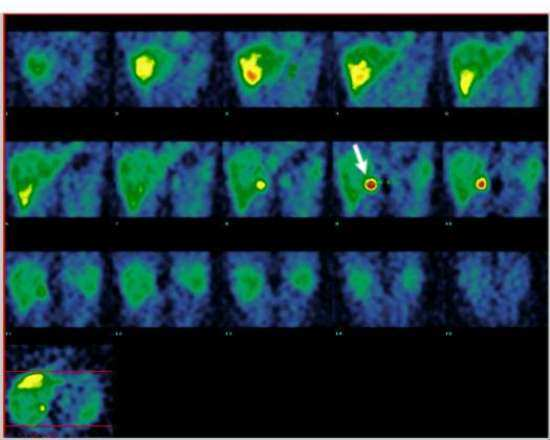 Řezy koronální pořízené za 24 h od počátku vyšetření Zvětšený koronální řez - viz šipka / Feochromocytom/ ( 13) Možnosti vyšetření neuroendokrinních nádorů Neuroendokrinní nádory mají svůj původ v