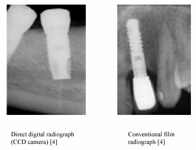 Filmová radiografie Diagnostické roentgenové záření je obvykle ~ 30 kev, které poskytuje optimální kontrast mezi měkkou tkání a kostí.