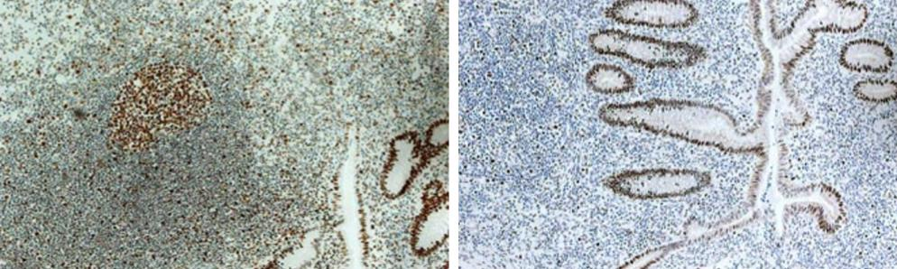 Obrázek 22 Apendix, optimální (vlevo) a nedostačující stanovení (Vyberg, 2005) Optimální stanovení MSH2 na tkáni apendixu vykazuje