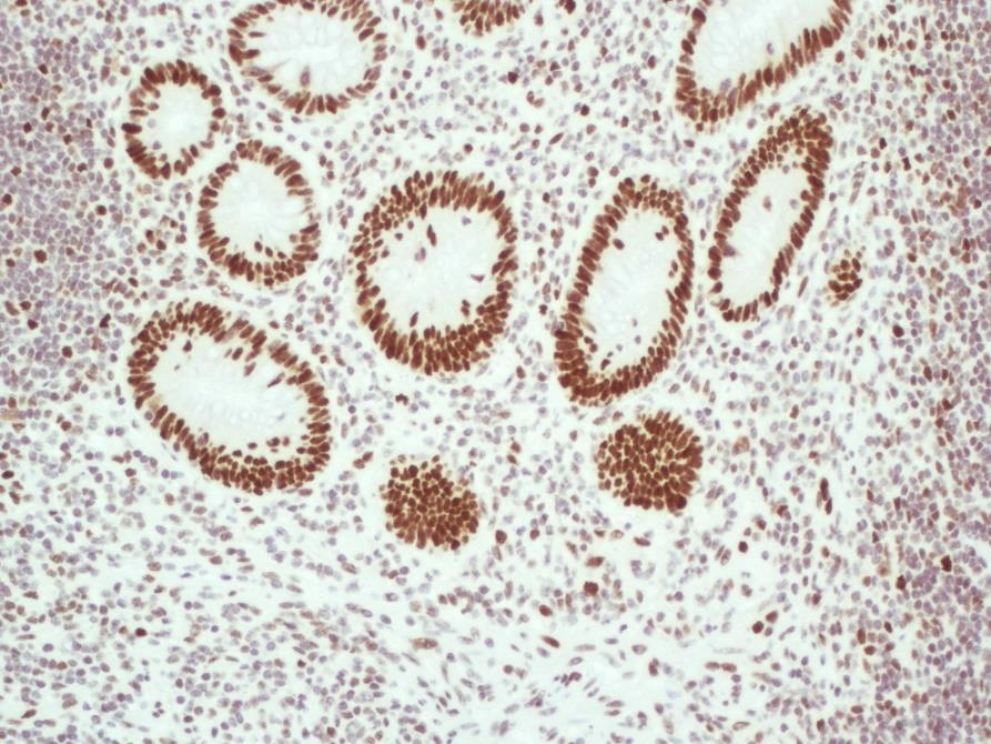 Obrázek 23 Apendix, testovací sklo NordiCQ, zvětšení 150x Z obrázku 23 je patrná střední až silná reakce jader všech buněk, což odpovídá pozitivní reakci protilátek MSH2 s antigeny buněk apendixu.