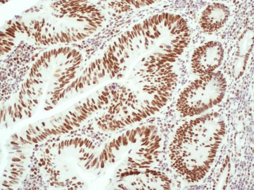 Obrázek 25 Adenokarcinom s normální expresí MSH2, testovací sklo NordiQC, zvětšení 150 x Všechny rakovinné buňky adenokarcinomu tlustého střeva s normální expresí MSH2 (Obrázek 25) vykazují