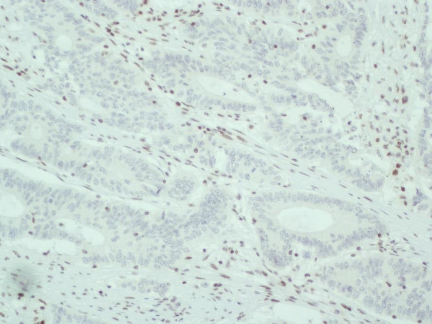 150x Obrázek 27 Adenokarcinom se ztrátou exprese MSH2, testovací sklo NordiQC, zvětšení Neoplastické buňky adenokarcinomu tlustého střeva se ztrátou exprese MSH2 (Obrázek 27) nevykazují žádnou reakci.