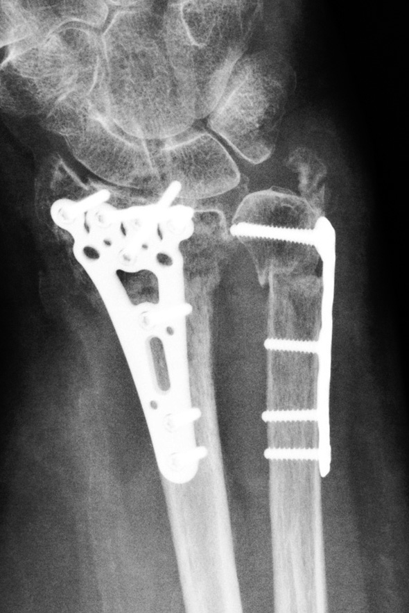 zlomeninami distální části vřetenní kosti. Tyto typy zlomenin distálních konců obou kostí bývají následkem vysokoenergetických mechanismů úrazu (1).