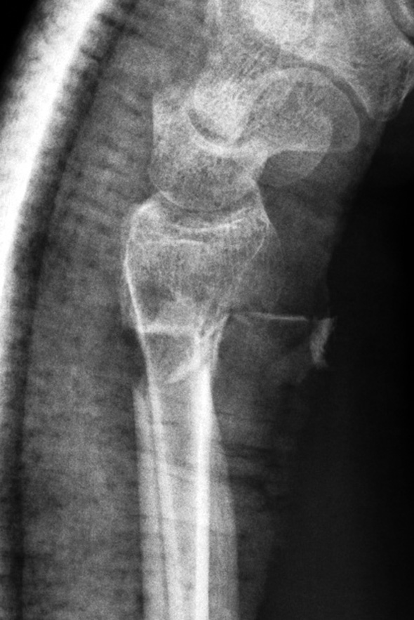 Nejsou-li dostupné úrazové snímky a hodnotíme-li zlomeninu distálního radia pouze na rentgenových snímcích v sádrové fixaci, může být zlomenina distální ulny snadno přehlédnuta (obr. 3).