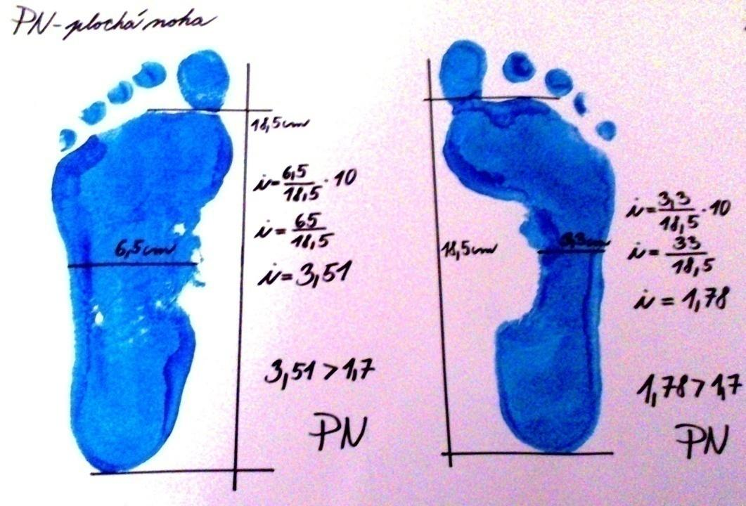 noha správně klenuta, je hodnota indexu do 1,6 plochá noha pak nabývá hodnot indexu 1,7 