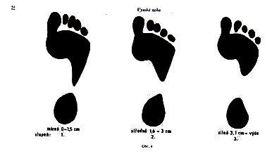 Vzhledem k tomu, že se mezi zkoumanými jedinci objevily plantogramy s vysokou nohu, vizuální škála od Josefa Klementy se pro mou práci jevila