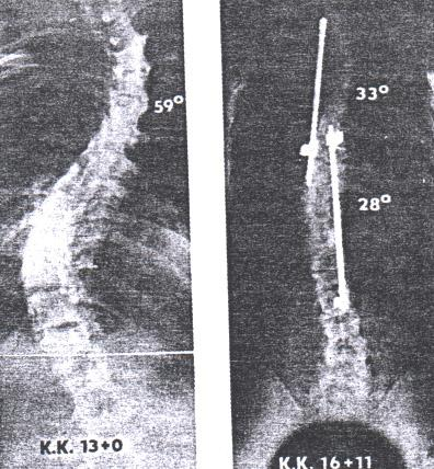 Operační léčení Nad 40 st při rychlé progresi Nad 50 st vždy operace Princip: korekce křivky spondylodéza