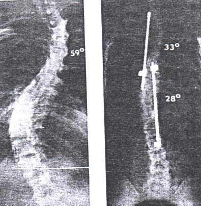 Cíl operace korekce křivky zabránit progresi omezit zhoršování plícních funkcí - (cor