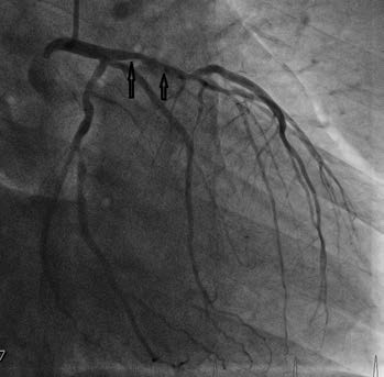 2. Nález byl ošetřen implantací a) lékového stentu do RIA; b) dvou lékových stentů do RC; c) RMS a dvou lékových stentů do ACD a b c u nemocných s nediagnostickým výsledkem zátěžových testů za