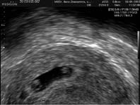 Při bočním pohledu se v oblasti předního mozku vytváří základ oka, v tuto chvíli tmavě zbarvená ploténka. Vytváří se také základ vnitřního ucha. Ve výši srdečního hrbolu se vyvíjejí horní končetiny.