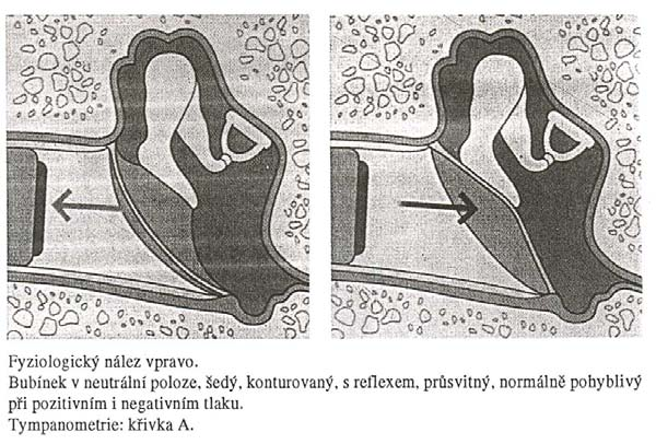Otoskopické vyšetření umožňuje podle vzhledu bubínku posouzení změn ve středouší. Na bubínku se hodnotí tyto parametry: a. poloha b. barva c. stupeň průsvitnosti d.
