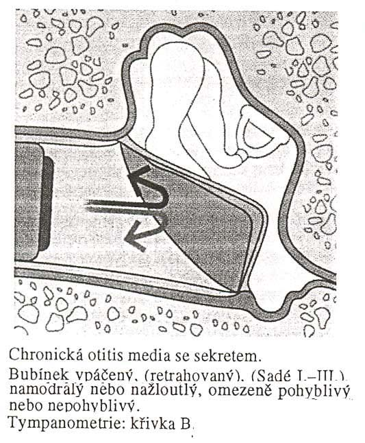 Obrázek 13: Bubínek se zavedenou ventilační trubičkou [4] 4.3.3. Otomikroskopie Otomikrokroskopie je vyšetření ucha pomocí mikroskopu, který velmi zpřesňuje diagnostiku středoušních onemocnění.