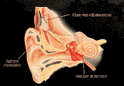 2 KOCHLEARNÍ IMPLANTÁT 2.1 Stavba a funkce kochleárního implantátu Kochleární implantát je sluchová náhrada určená pro osoby s velmi těžkým postižením sluchu nebo pro osoby zcela neslyšící (Tichý, T.