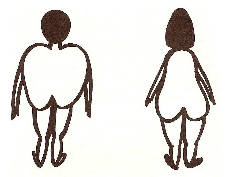 Obr. 1 Typy otylosti podle charakteru rozložení tuku Vlevo otylost tvaru jablka neboli mužského typu (androidní) s hromaděním tuku v oblasti hrudníku a břicha Vpravo otylost tvaru hrušky neboli
