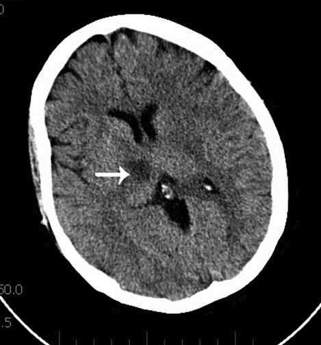 Otázka č. 4: Jaký vlyv měla úprava medikace na nynější onemocnění? Otázka č. 5: Jaký je mechanismus účinku Warfarinu? Otázka č. 6: Vysvětlete, proč je u pacienta s fibrilací síní indikovaná antikoagulační léčba?