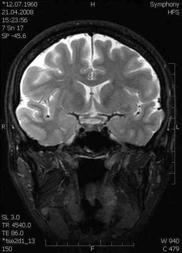 MRI T2