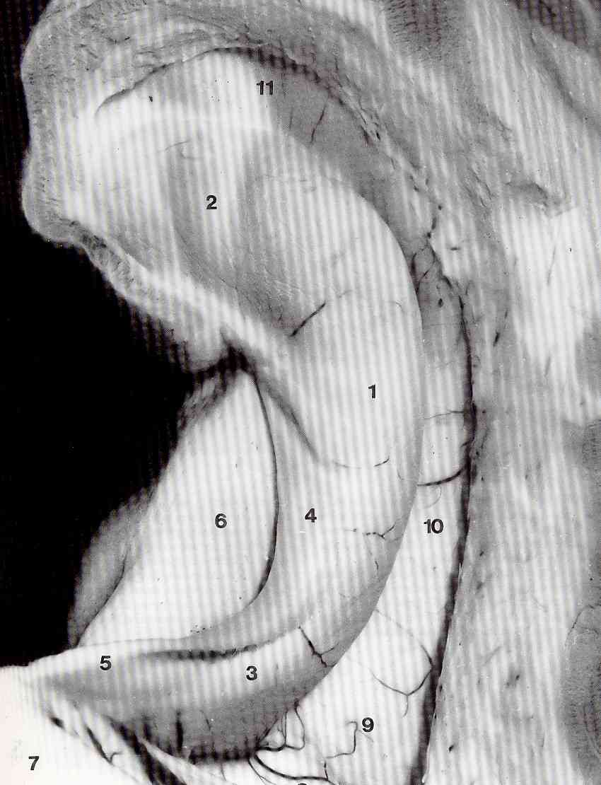 1- hippocampal body 2 head and digitationes hippocampi 3 hippocampal tail 4 fimbria (fornix) 5 fornix