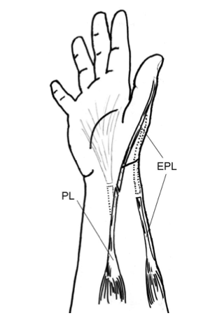 Obrázek 3. Přenos šlachy m. palmaris longus na m. extensor pollicis longus (Sammer & Chung, 2009, 173e) Pro obnovu funkce extenze prstů v MP kloubech, tedy m.