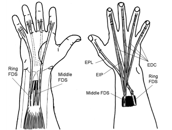 jsou vedeny přes interoseální membránu (Obrázek 5) (Sammer & Chung, 2009) nebo lze šlachu vést i přes ulnární okraj (Ratner, Peljovich, & Kozin, 2010). Obrázek 5.