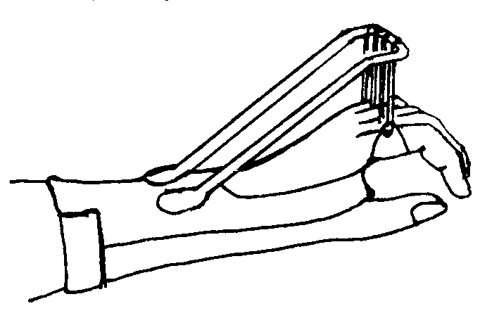 Možnosti dlahování jsou: - rigidní fixace - dynamická dlaha (systém lanek a gumiček připevněných na dlaze, dovoluje aktivní flexi a pasivní extenzi prstů) (Obrázek 6) Obrázek 6.