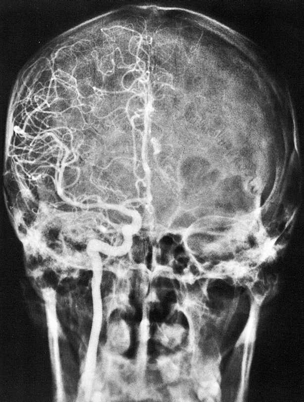 RTG snímek hlavy v předozadní projekci Angiografie = kontrastní vyšetření mozkových cév pomocí roztoku I