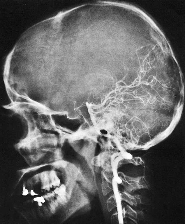 RTG snímek hlavy v boční projekci Angiografie = kontrastní vyšetření mozkových cév pomocí