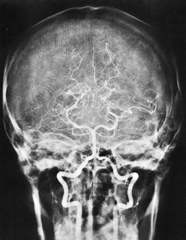 RTG snímek hlavy v předozadní projekci Angiografie = kontrastní vyšetření mozkových cév pomocí roztoku