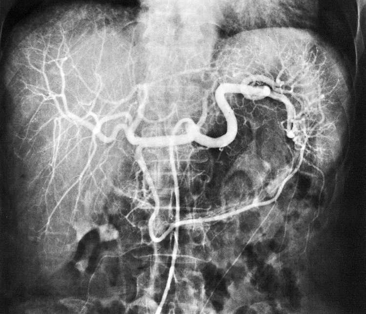 RTG snímek břicha = břišní aortografie Kontrastní snímek větví truncus coeliacus při použití roztoku I. Truncus coeliacus. a.gastrica sinistra.