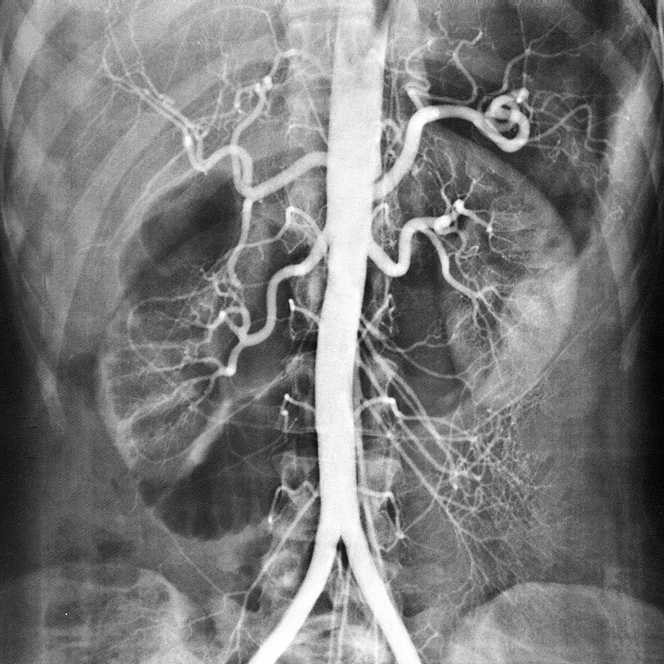 Rtg snímek břicha s kontrastní náplní v břišní aortě = angiografie = břišní aortografie Zobrazení větví břišní aorty pomocí roztoku I 7. a.hepatica communis.