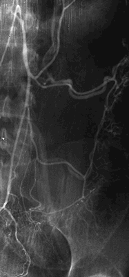 RTG snímek břicha = břišní aortografie Kontrastní snímek větví a.